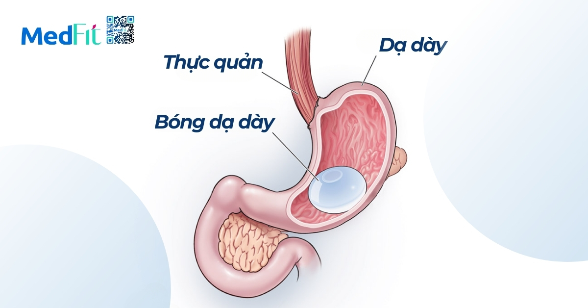 phương pháp đặt bóng dạ dày (hình minh họa)