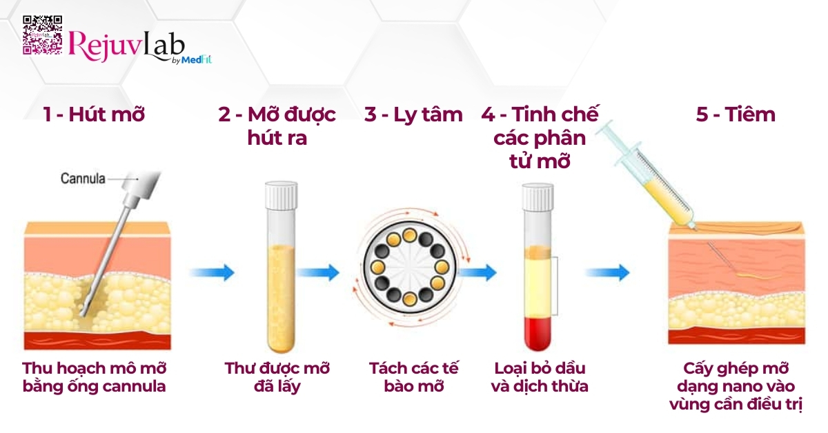 quy trình cấy mỡ tự thân lên mặt