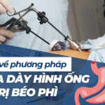 Tìm hiểu về phương pháp cắt dạ dày hình ống điều trị béo phì
