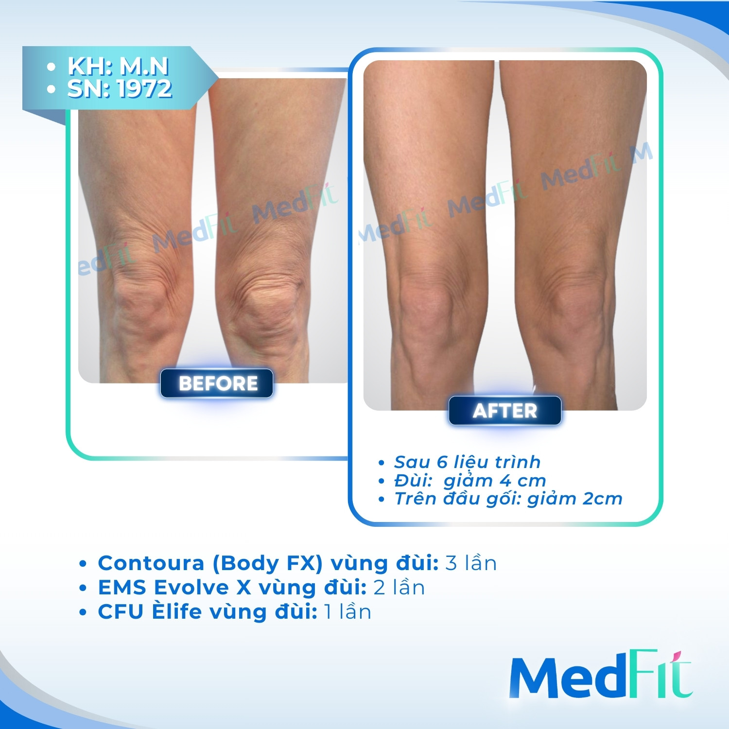 CLS vung dui Contoura CFU Evolve X 1