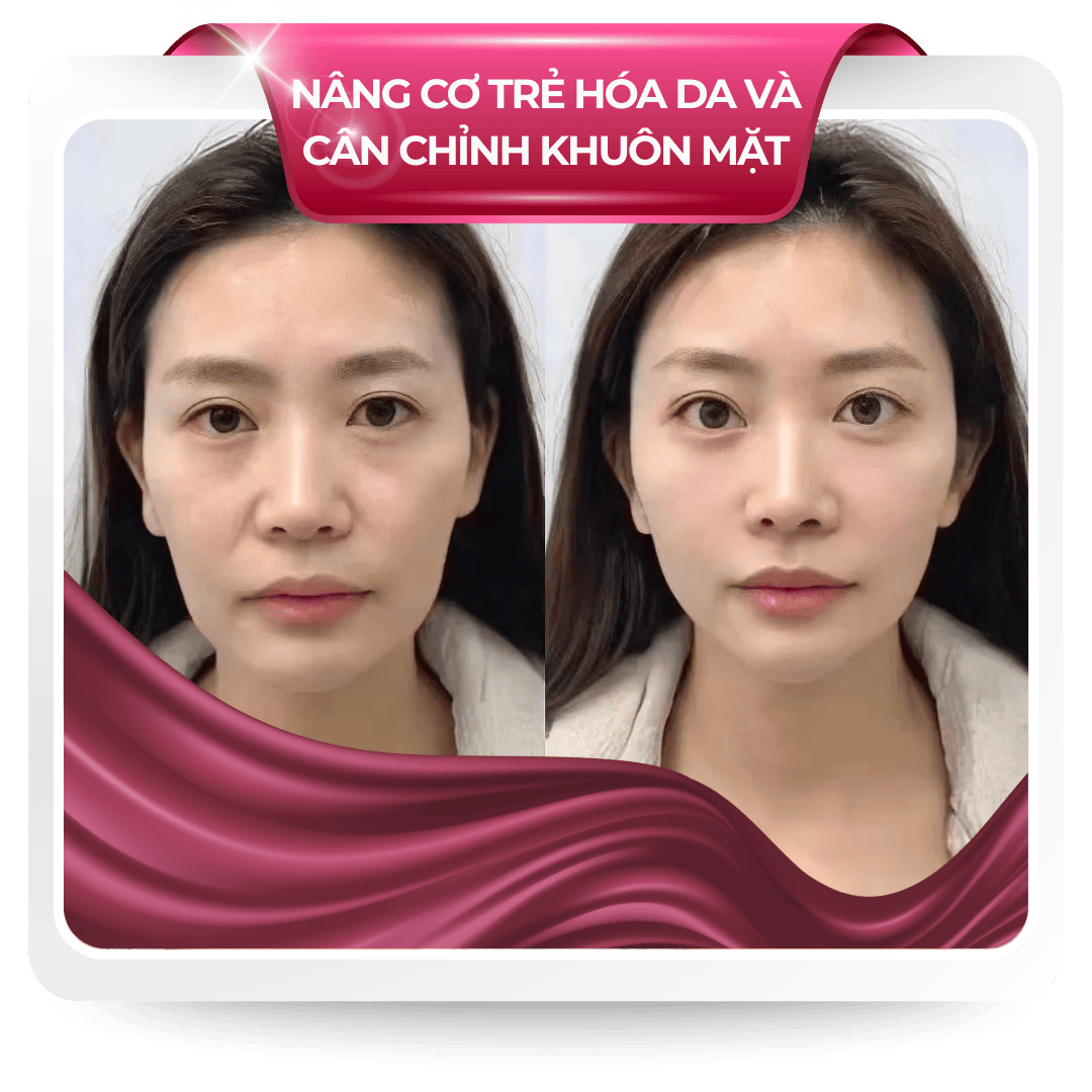 Nâng cơ trẻ hóa da và cân chỉnh khuôn mặt