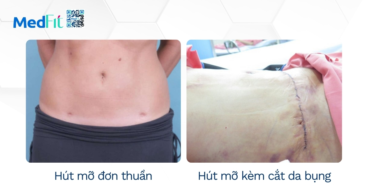 So sánh hút mỡ - Hút mỡ kèm cắt da bụng