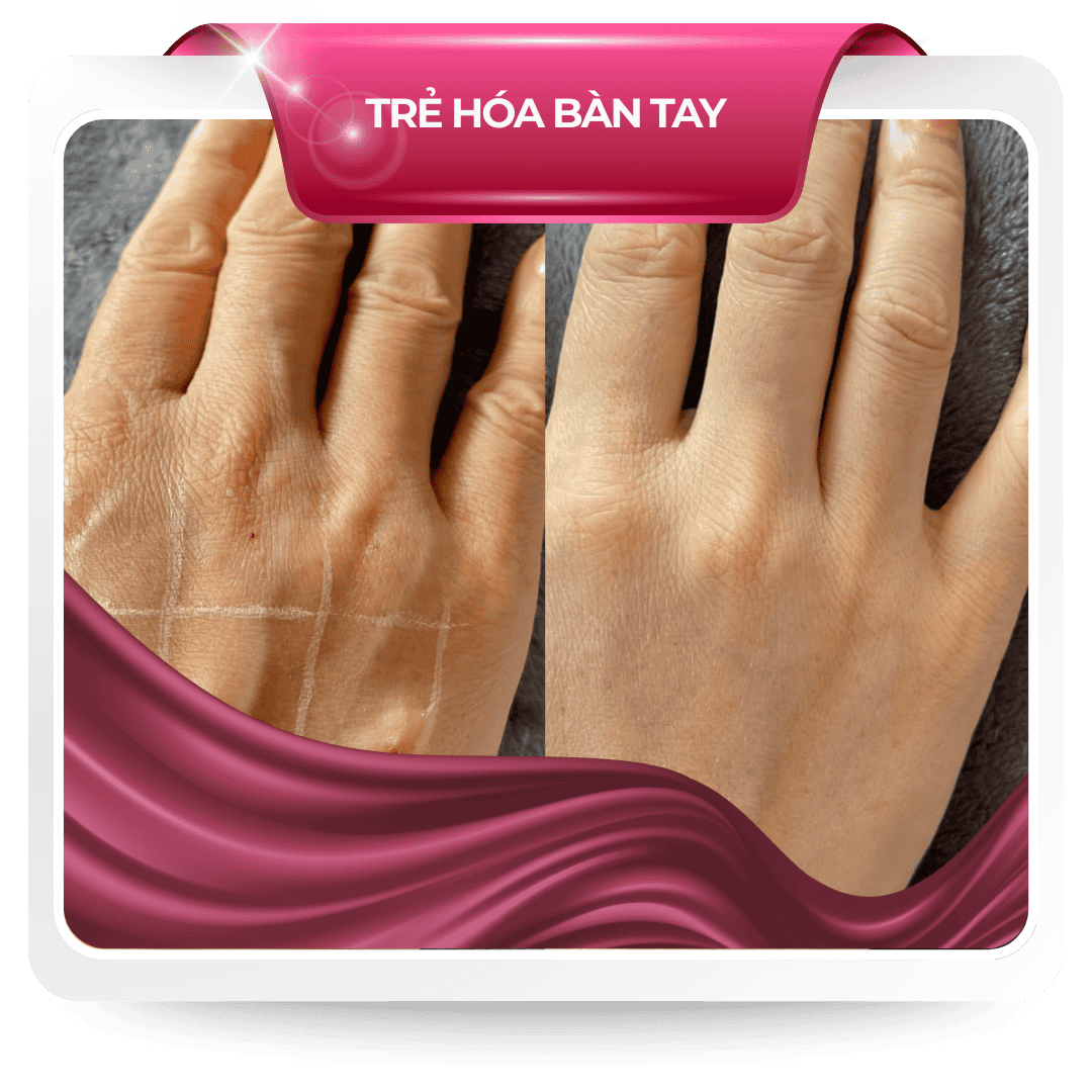 Trẻ hóa bàn tay