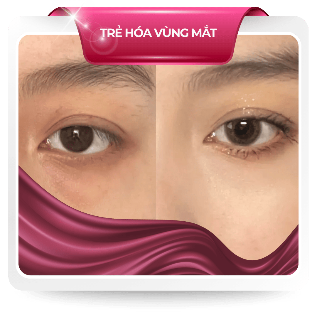 Trẻ hóa vùng mắt (1)