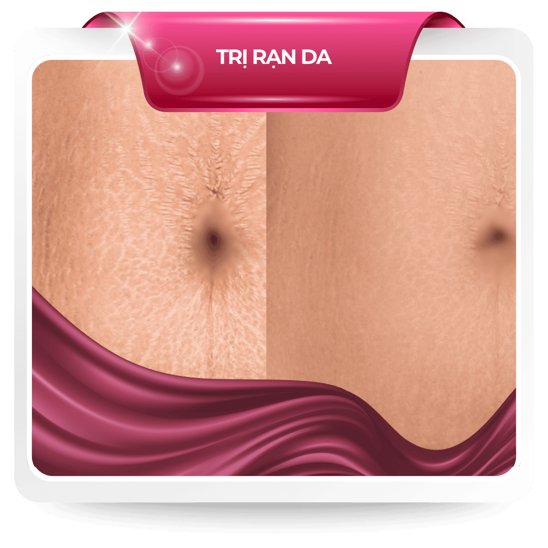 Trị rạn da