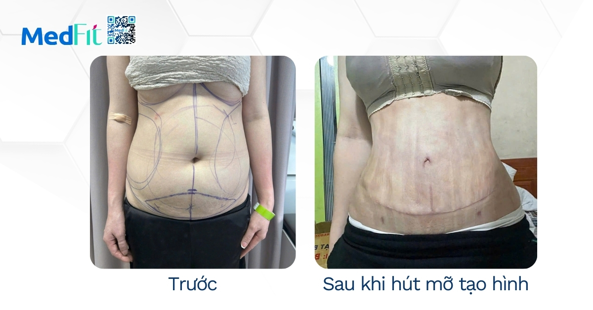 Trước - sau khi hút mỡ tạo hình
