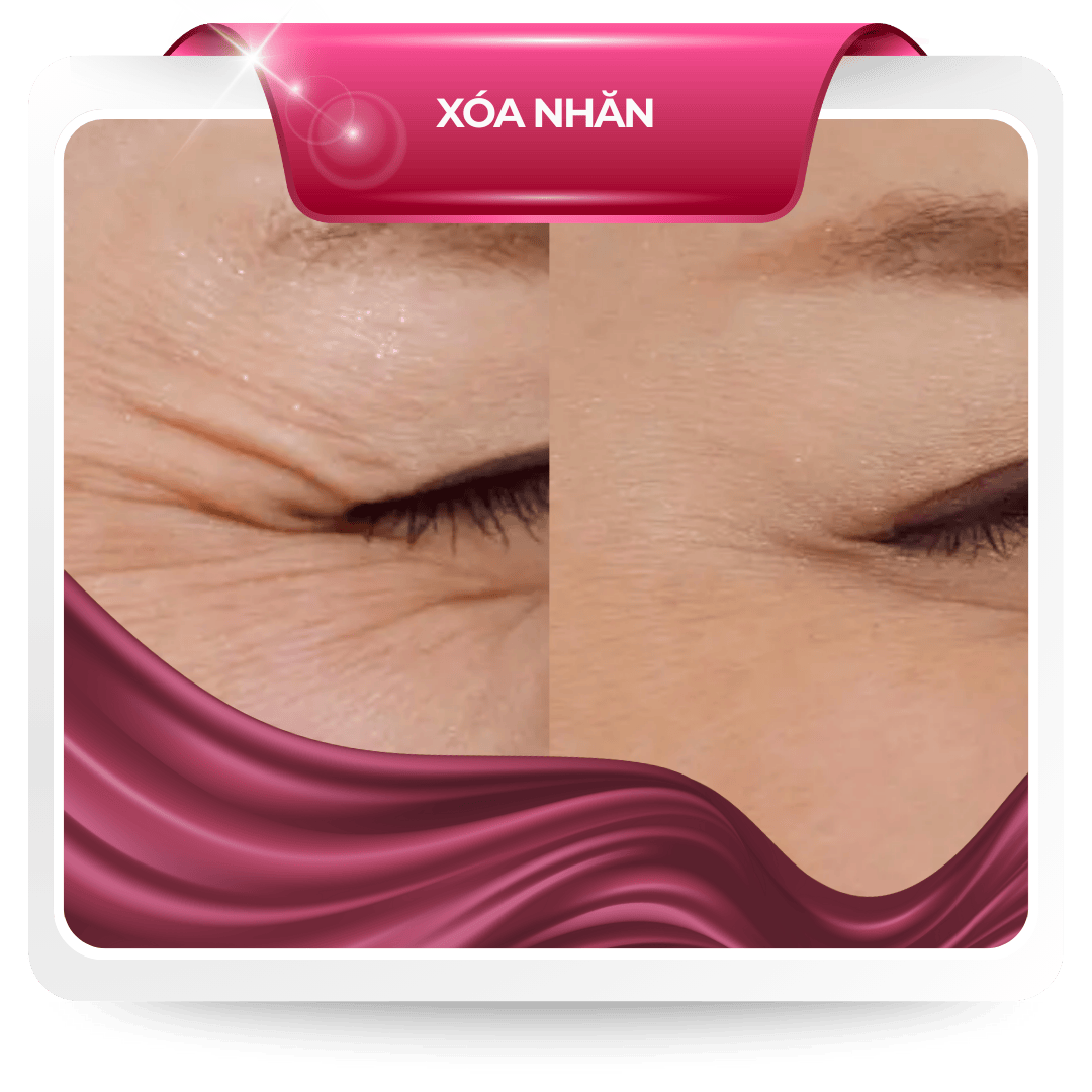 Xóa nhăn