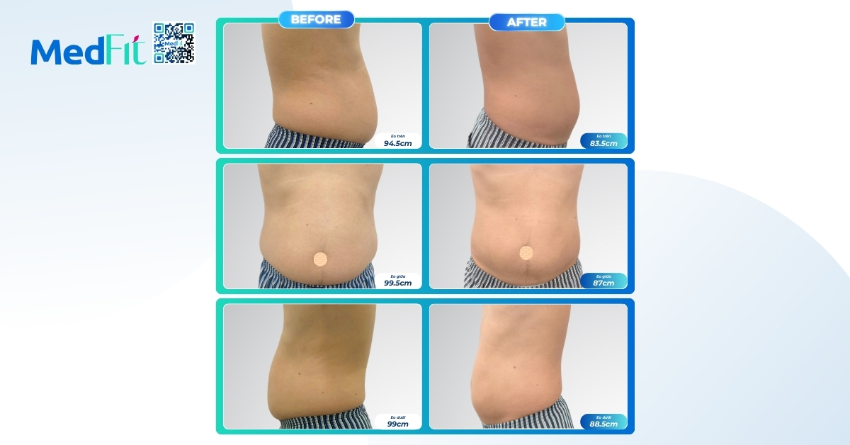 MedFit đồng hành cùng H.T trong hành trình giảm cân bền vững và kiểm soát bệnh lý tim mạch 4 ảnh vòng eo khách ht trước sau