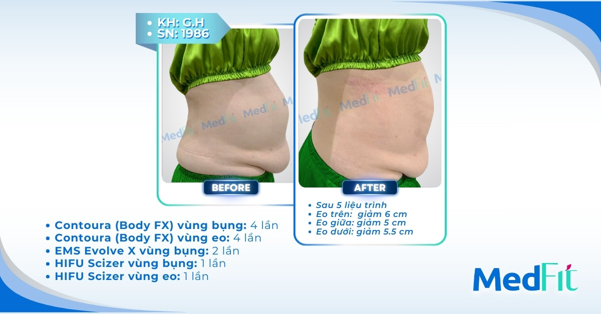 Giảm mỡ bụng ở đâu uy tín? 4 địa chỉ được đánh giá cao tại TP. HCM 7 ca lâm sàng giảm mỡ bụng tại medfit