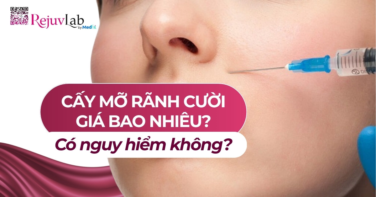 cấy mỡ rãnh cười giá bao nhiêu