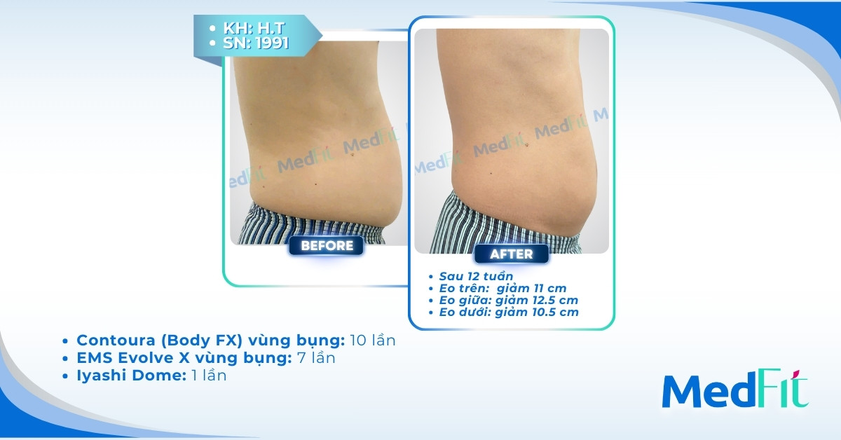 cls giảm mỡ bụng tại medfit