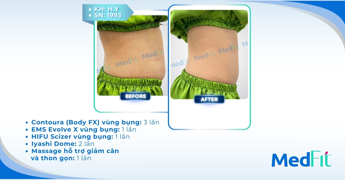 cls giảm mỡ bụng