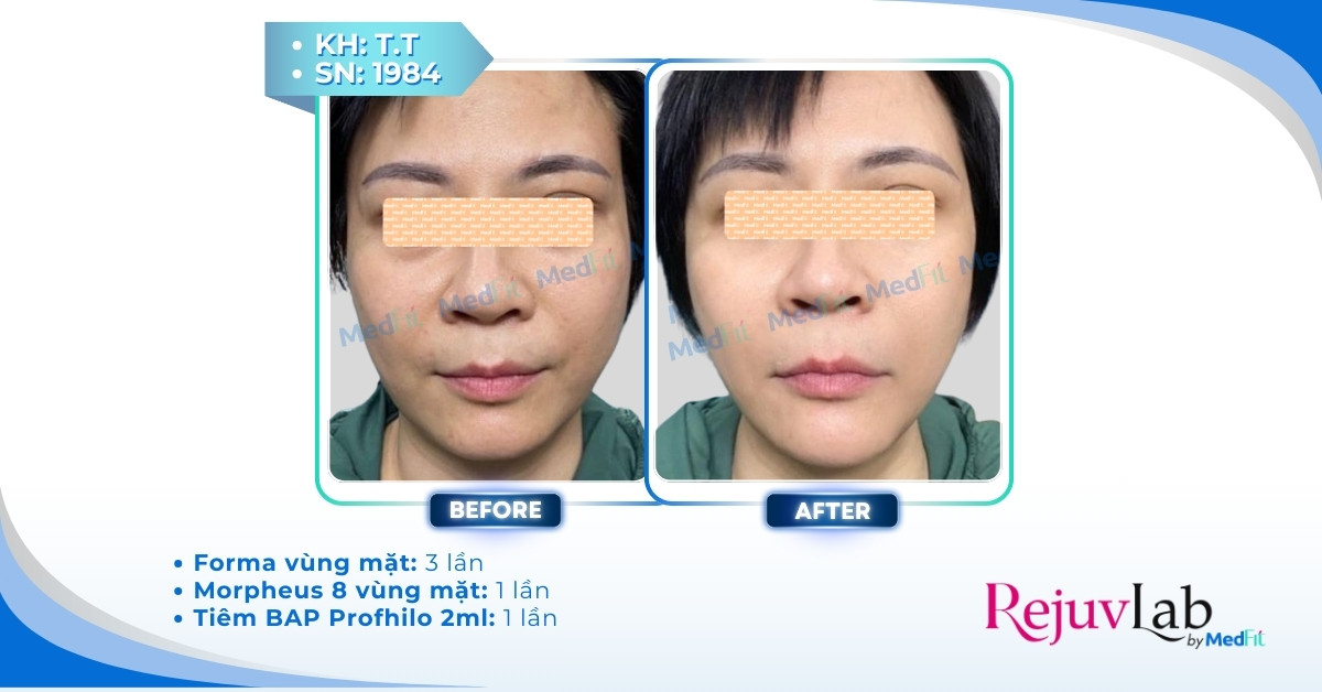 Liệu trình trẻ hóa da mặt giá bao nhiêu? Bảng giá các phương pháp phổ biến 3 cls trẻ hóa da mặt
