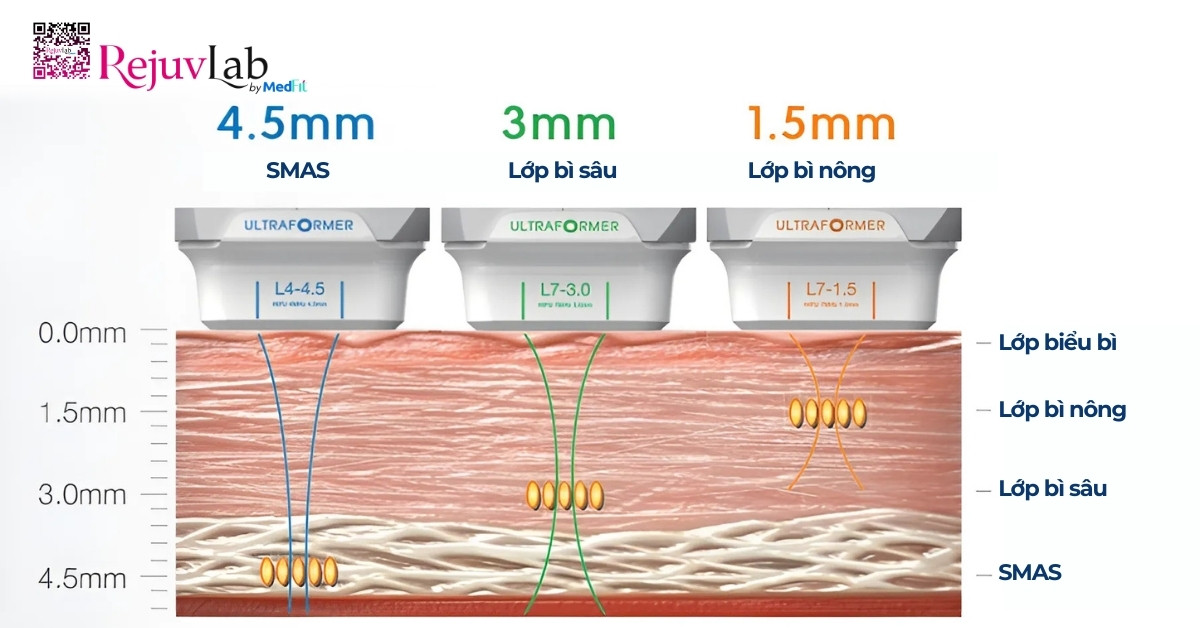 Nâng cơ HIFU giá bao nhiêu và nên thực hiện ở đâu? 1 độ xuyên sâu của hifu