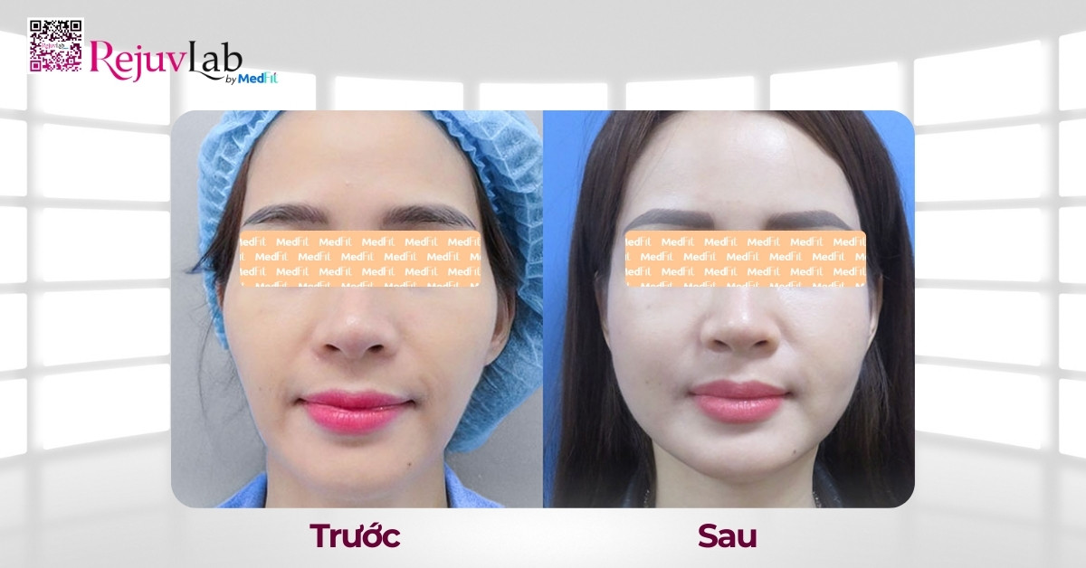 hiệu quả cấy mỡ má hóp
