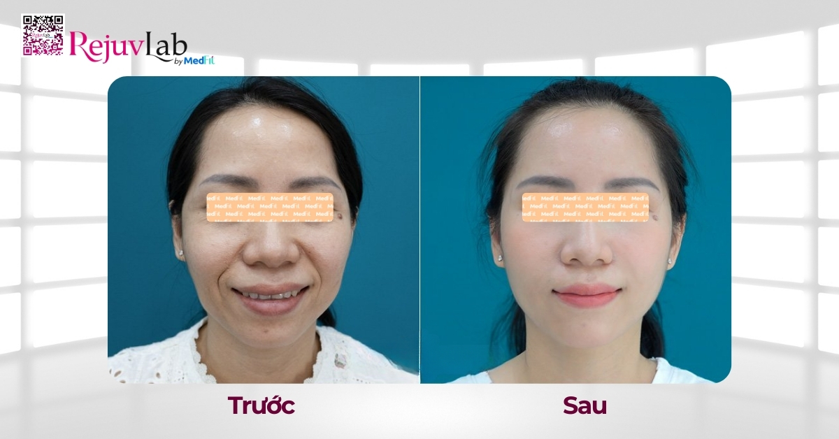 Cấy mỡ mặt baby hiệu quả ra sao? Có đáng thử không? 3 hiệu quả cấy mỡ mặt baby