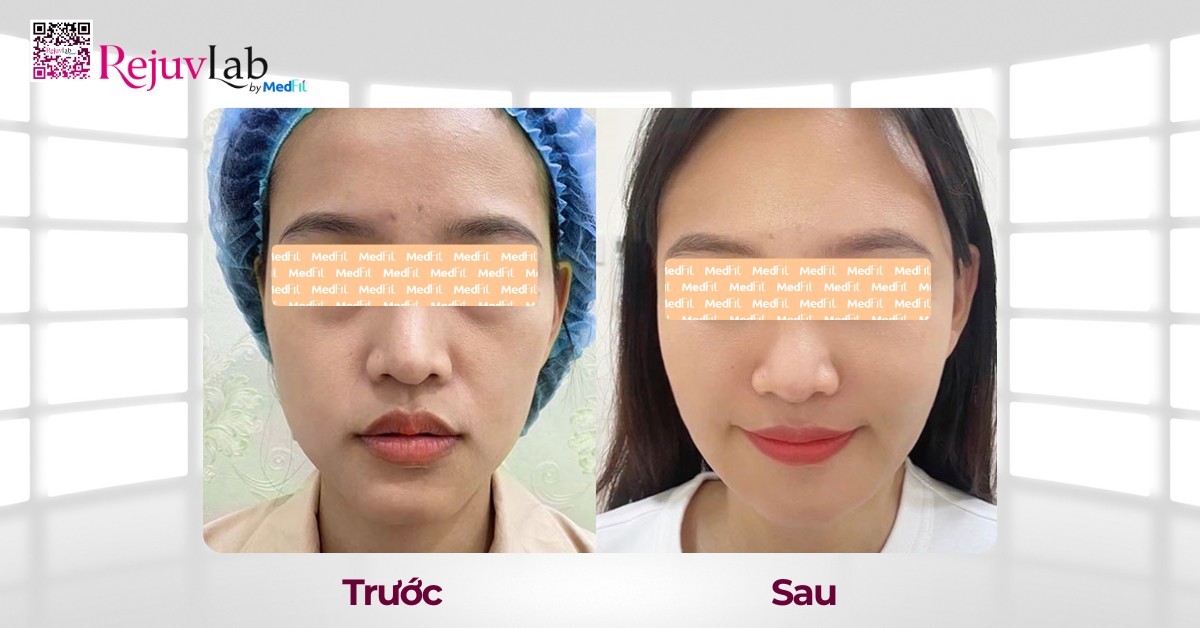 hiệu quả cấy mỡ tự thân lên mặt