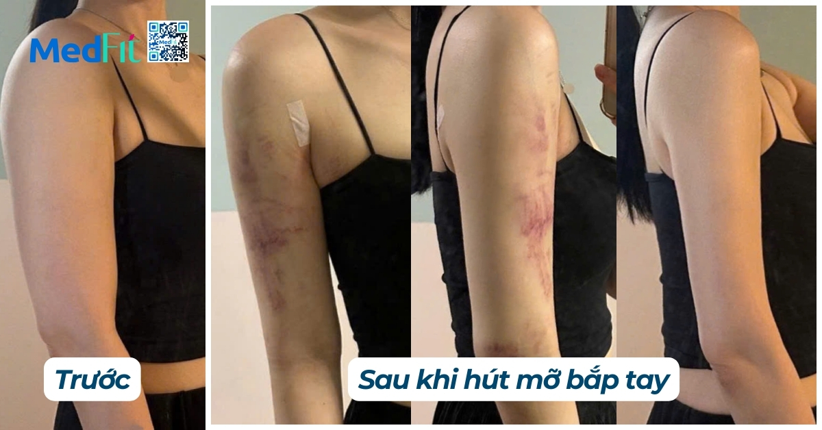 hiệu quả hút mỡ bắp tay