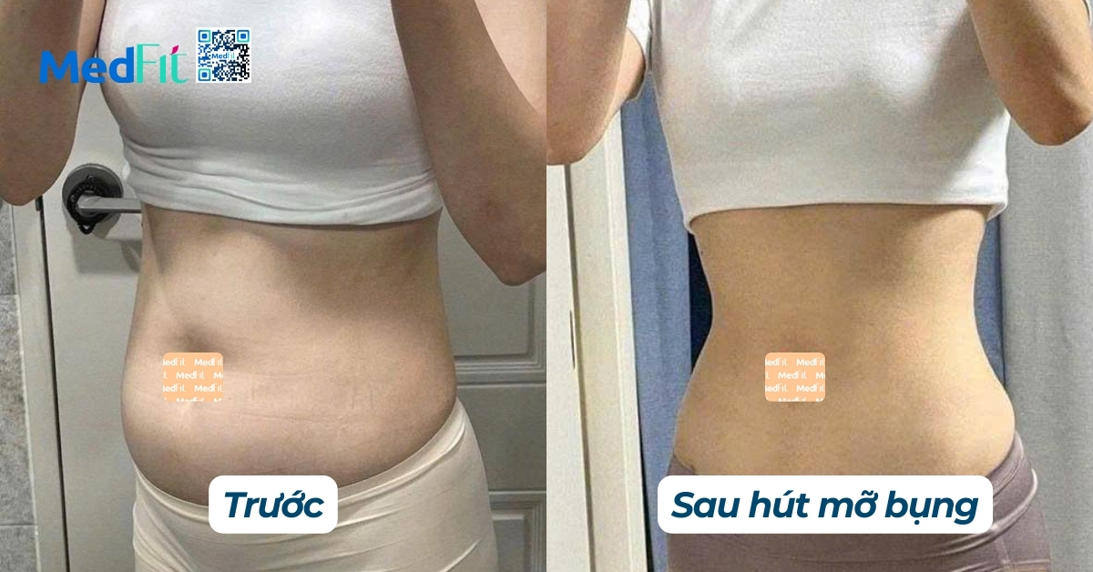 hiệu quả hút mỡ bụng