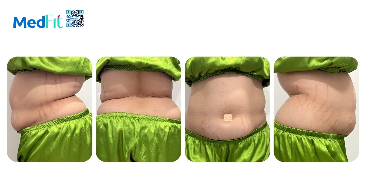 Tất cả những gì cần biết về béo phì ở nữ giới 1 hình minh họa béo phì ở nữ
