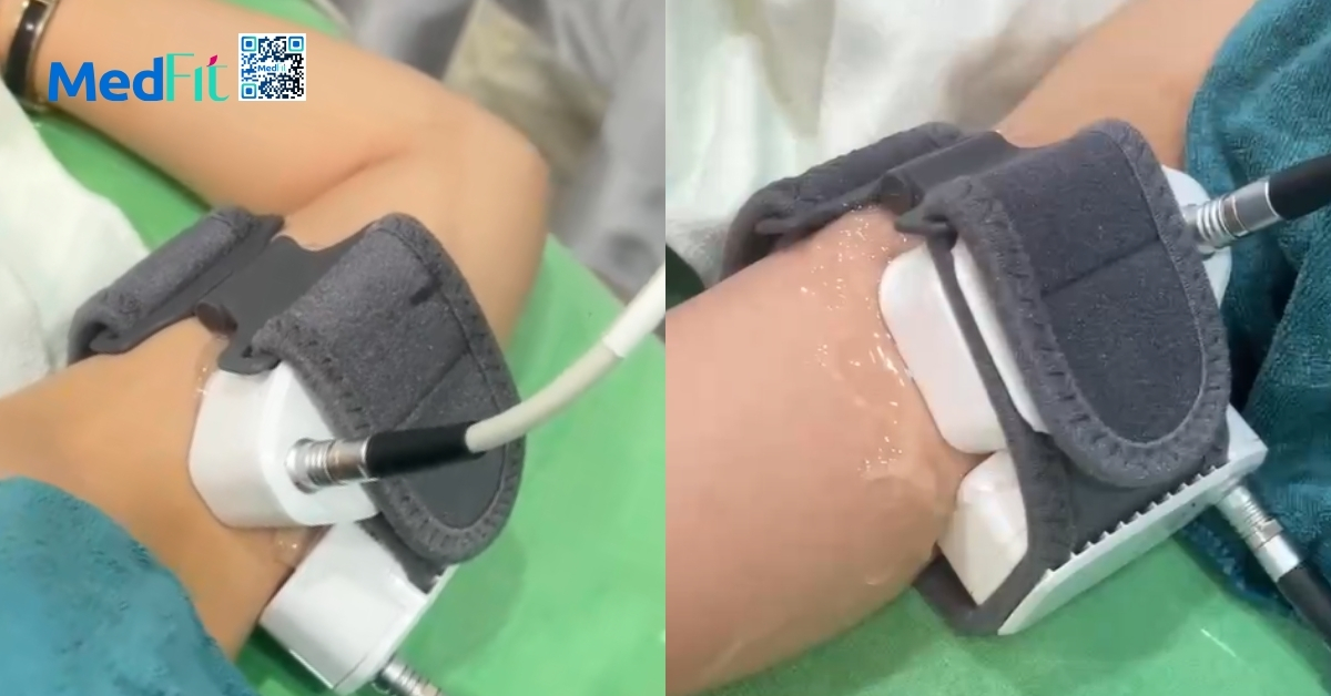 hình minh họa evolve x bắp tay