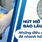 Hút mỡ có để lại sẹo không? Mẹo hạn chế sẹo hiệu quả 4 Hút mỡ bao lâu lành? Những điều cần biết để nhanh hồi phục