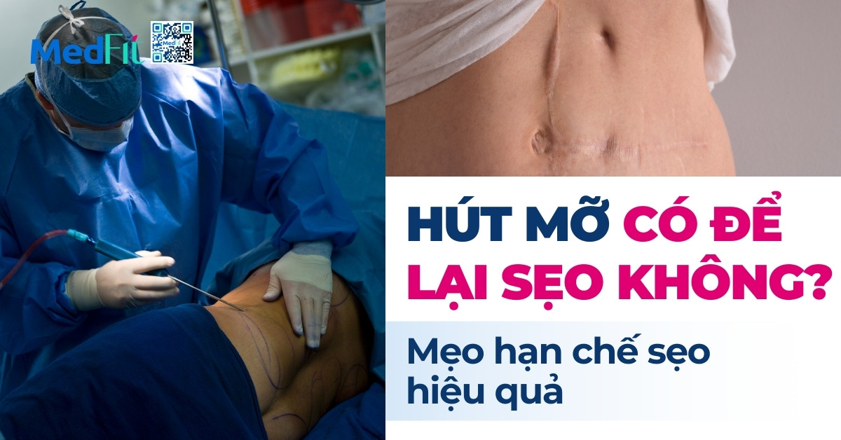hút mỡ có để lại sẹo không