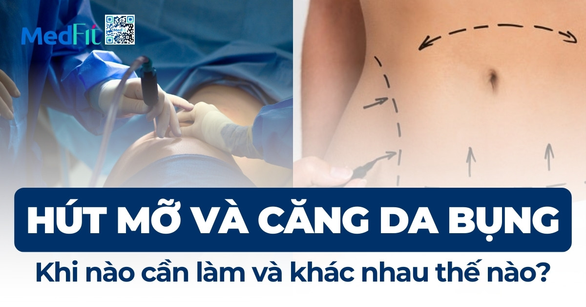 hút mỡ và căng da bụng khi nào cần làm và khác nhau thế nào
