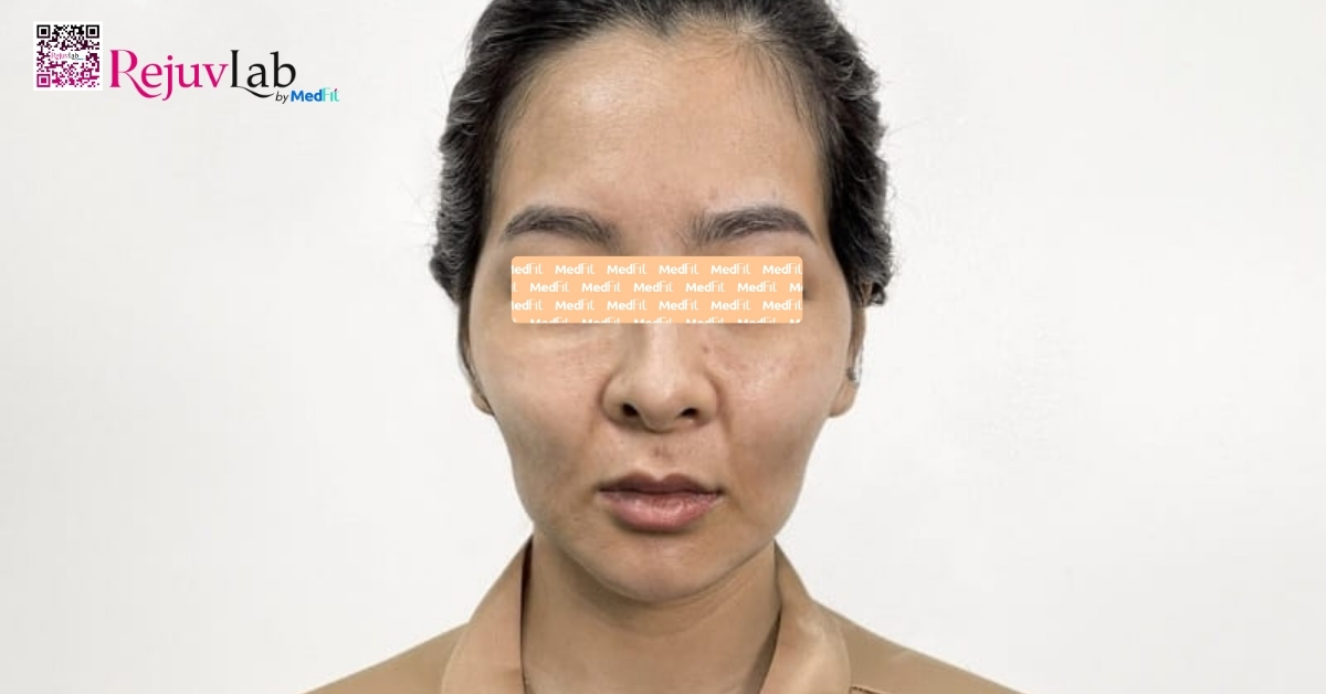 Cấy mỡ mặt baby hiệu quả ra sao? Có đáng thử không? 5 mặt hóp thiếu thể tích (hình minh họa)