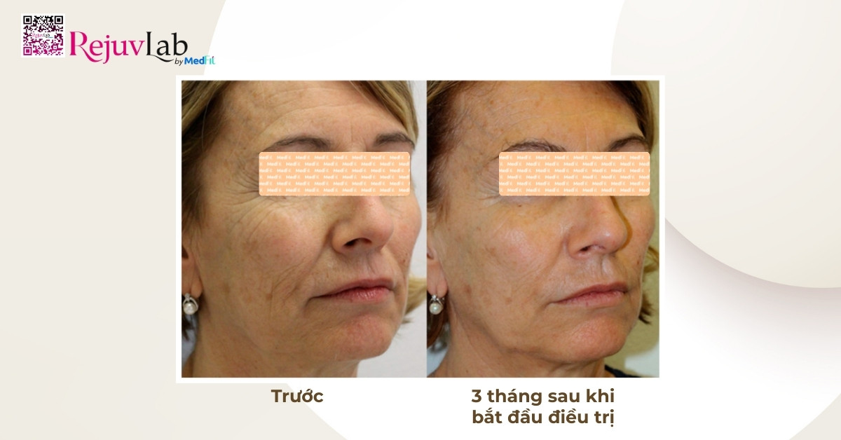 nghiên cứu chuỗi ca lâm sàng của profhilo structura