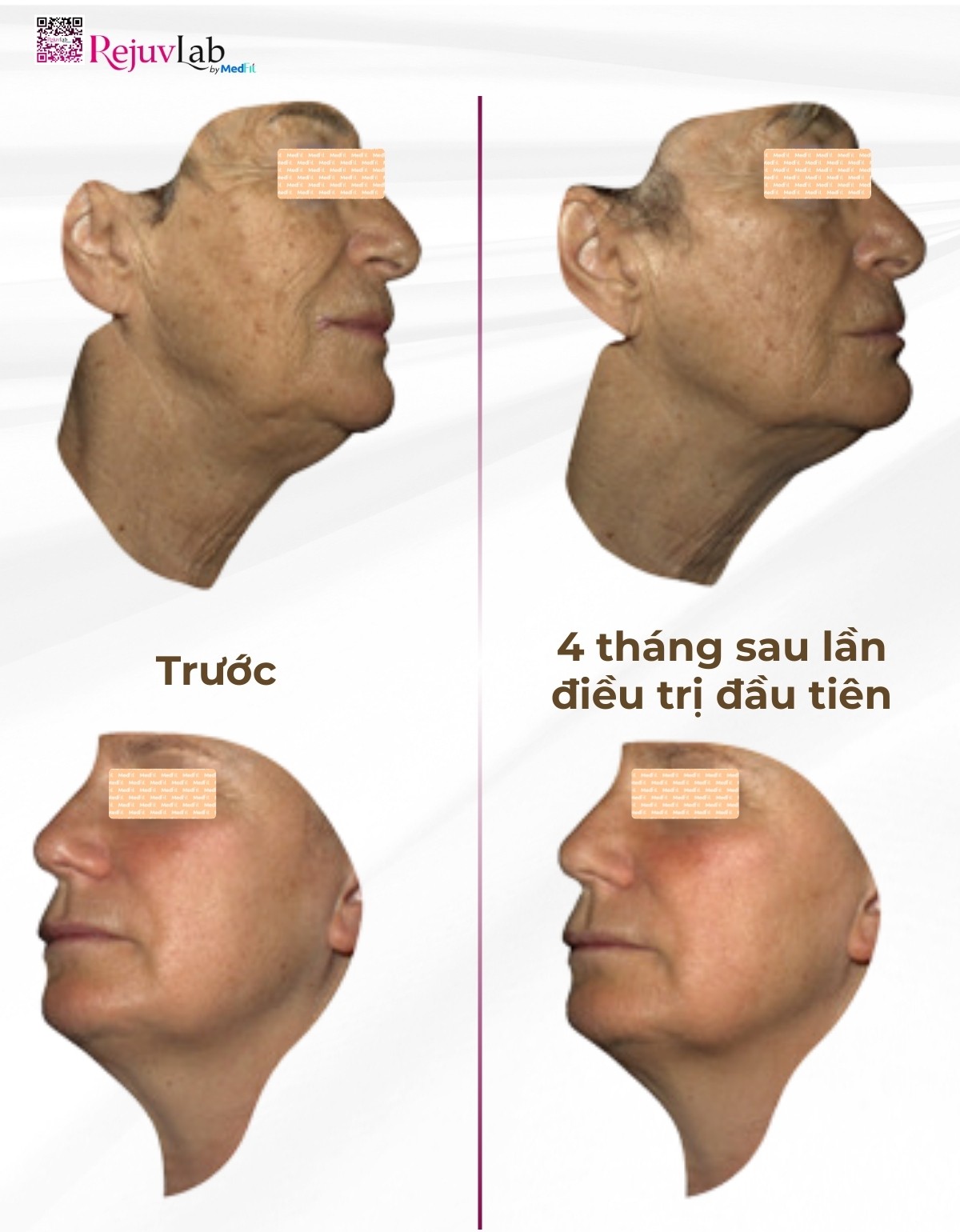 nghiên cứu quan sát thử nghiệm của profhilo structura