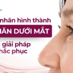 Nguyên nhân hình thành nếp nhăn dưới mắt và giải pháp khắc phục