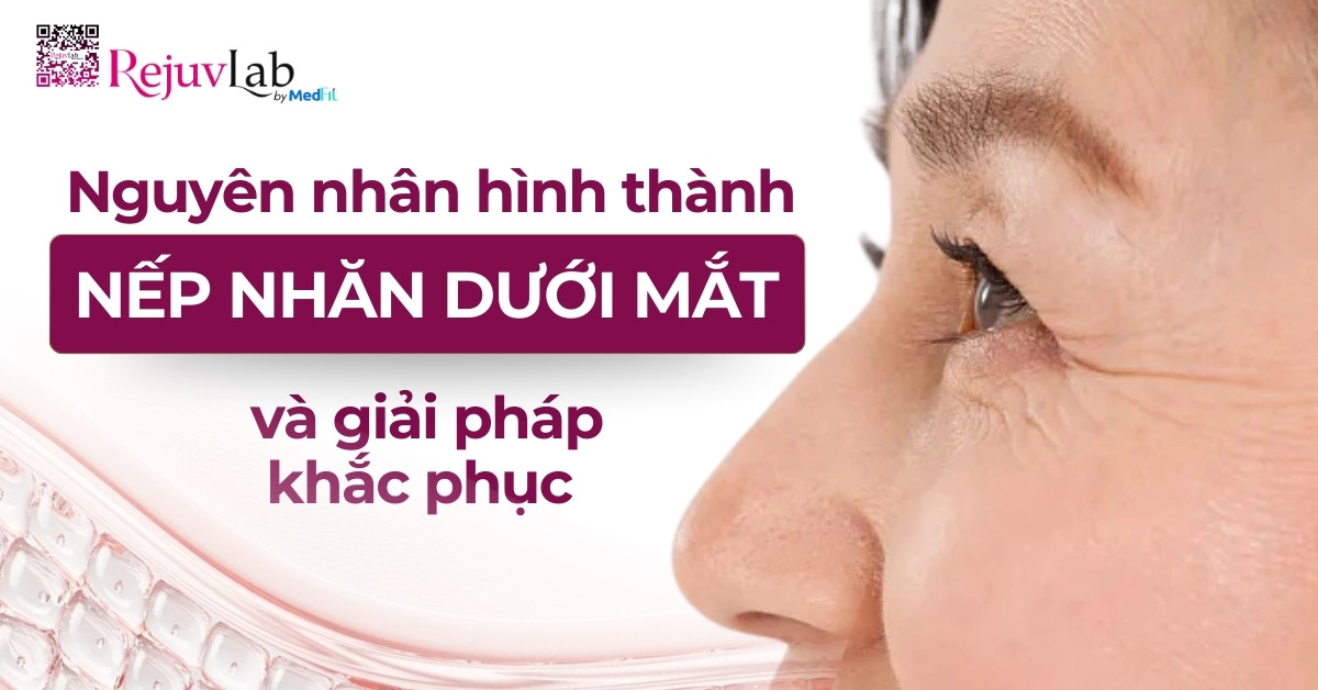 nguyên nhân hình thành nếp nhăn dưới mắt và cách khắc phục
