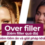 Over filler (tiêm filler quá đà): Nguy hiểm tiềm ẩn và giải pháp khắc phục