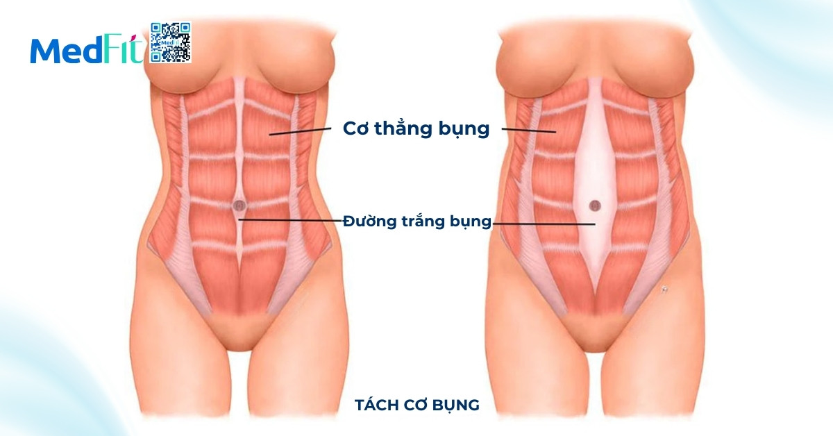 tách cơ bụng sau sinh (hình minh họa)