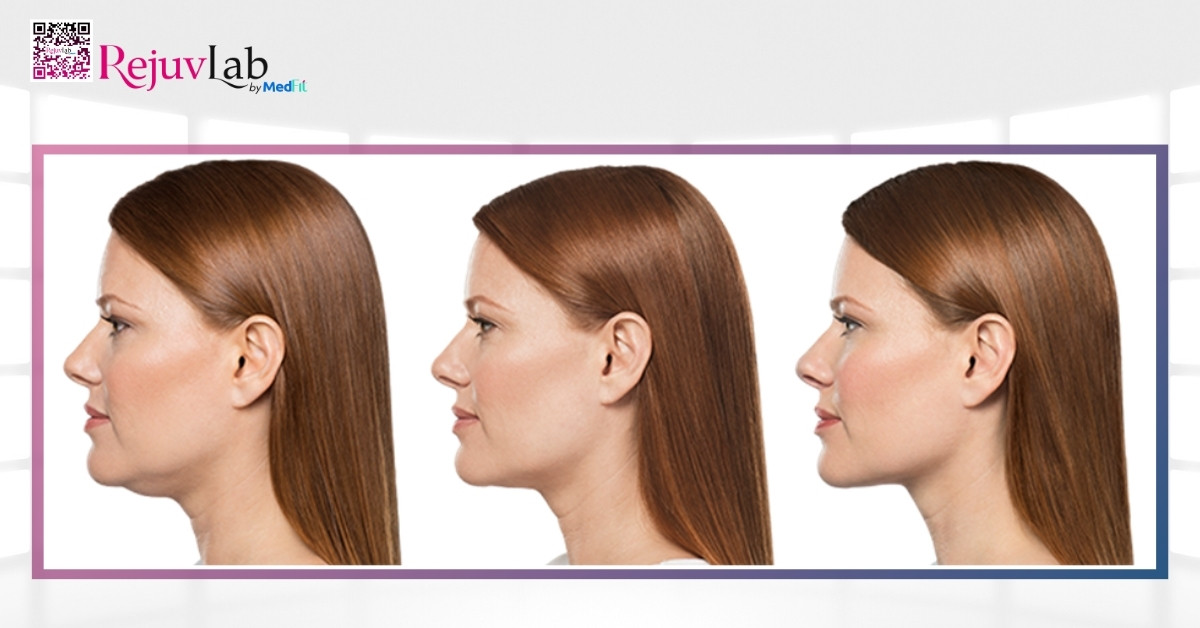 Hiệu quả của tiêm giảm mỡ cằm sau 3 buổi điều trị