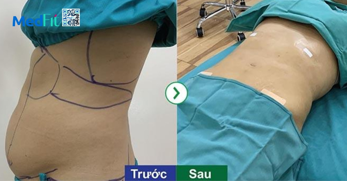 Hút mỡ toàn thân có nguy hiểm không? Những ưu điểm, rủi ro và lưu ý cần biết 3 Ưu điểm hút mỡ là thay đổi đường nét nhanh vì xử lý nhiều vùng trong một lần nên chỉ cần một giai đoạn hồi phục