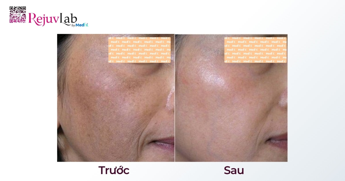 BA tiem meso tri nam