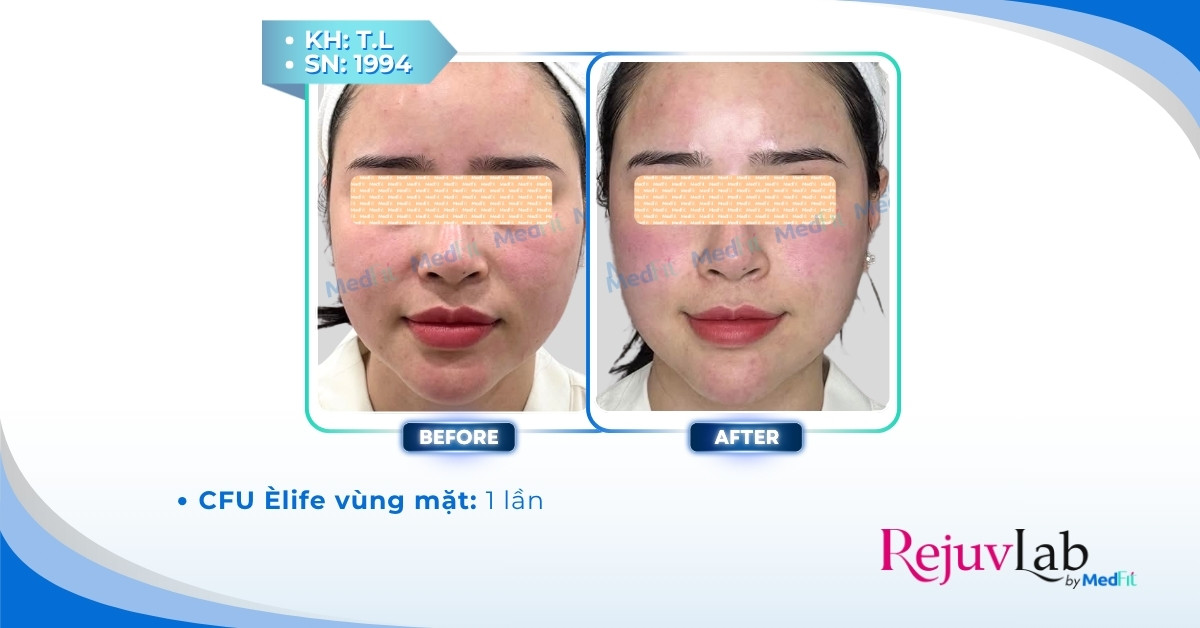 Ca lâm sàng giảm mỡ mặt bằng HIFU CFU tại MedFit