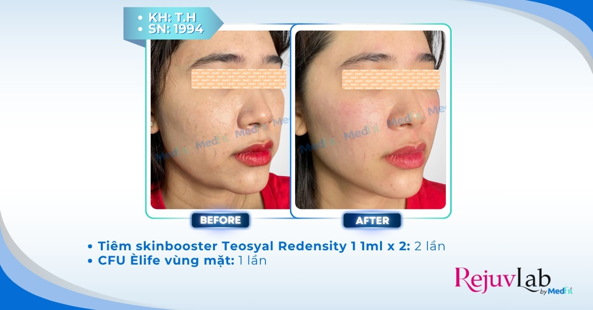 CLS tiem redensity 1