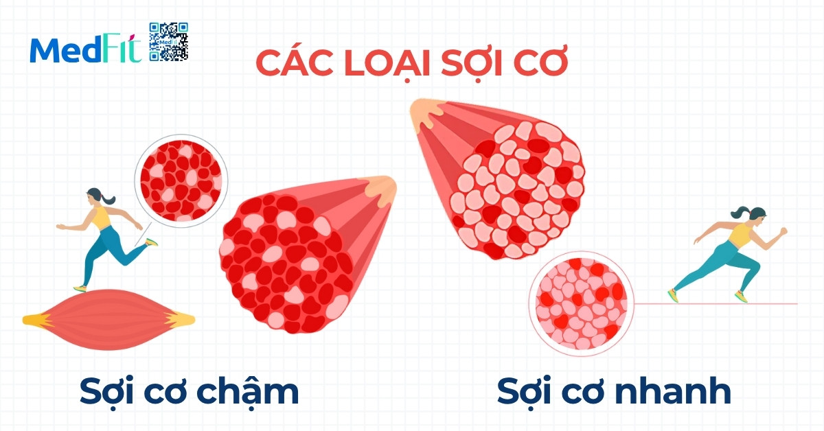 Tại sao cơ tay, cơ lưng lại khó tăng khi tập luyện giảm cân? 5 Các sợi cơ nhanh (type II) có khả năng phát triển mạnh mẽ hơn về kích thước, trong khi sợi cơ chậm (type I) lại thiên về sức bền và kháng mỏi