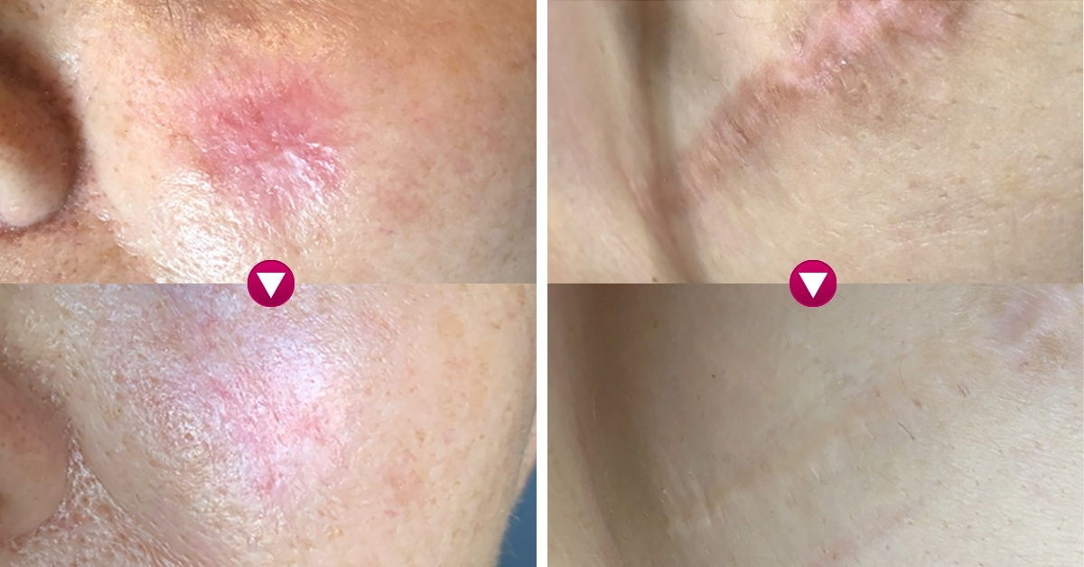 Cải thiện nhiều tình trạng sẹo