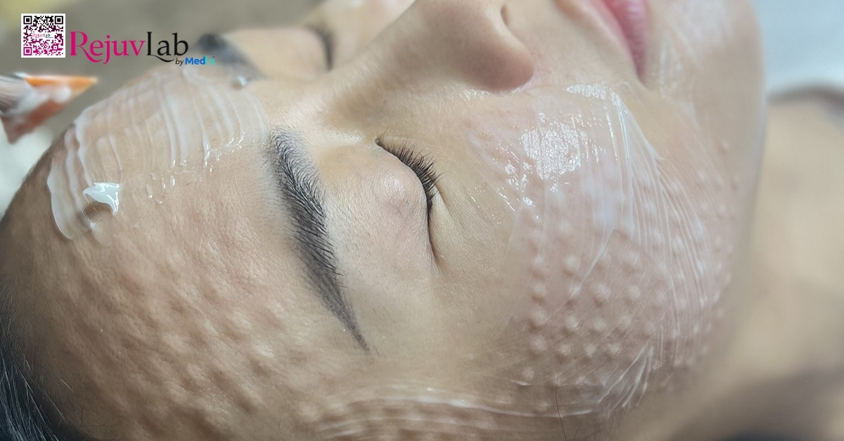 Hướng dẫn chăm sóc da sau tiêm meso để da căng bóng, mịn màng 1 chăm sóc da sau tiêm meso