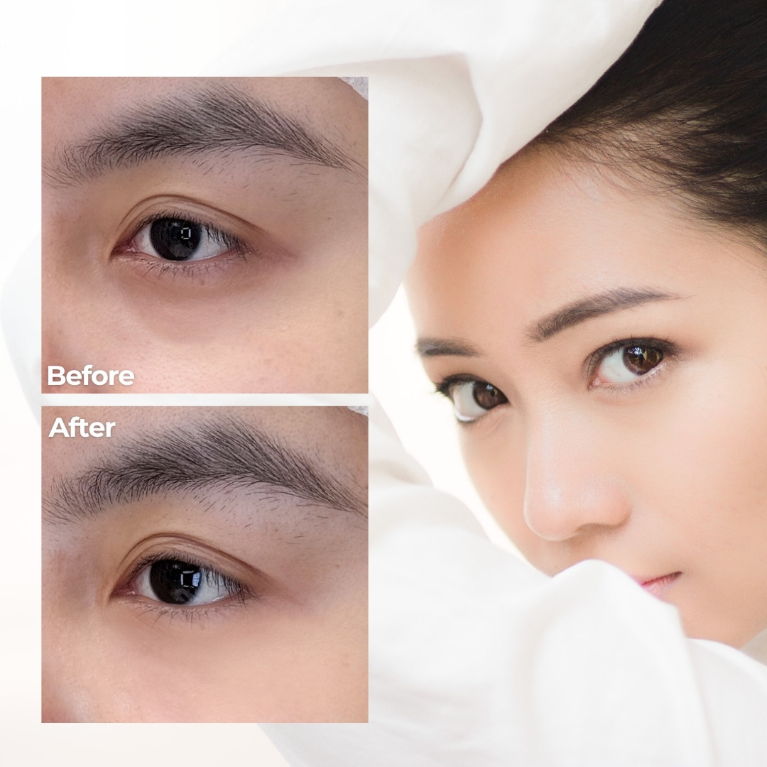 Giảm quầng thâm