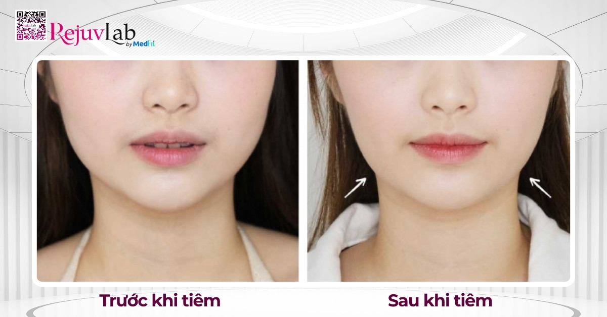 Tiêm Botox gọn hàm giá bao nhiêu? Review hiệu quả thực tế tại RejuvLab 3 Hiệu quả tiêm Botox gọn hàm thường rõ rệt sau khoảng 2-4 tuần