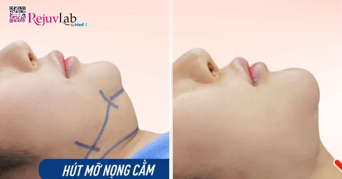 Chi phí hút mỡ nọng cằm hiện nay dao động từ 20 - 35 triệu đồng, thay đổi tùy thuộc vào nhiều yếu tố