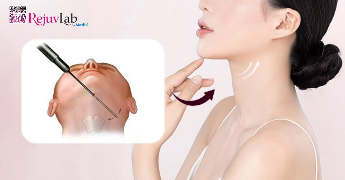 Hút mỡ nọng cằm là thủ thuật thẩm mỹ được thiết kế để loại bỏ phần mỡ dư thừa, trả lại sự rõ nét cho viền hàm và giúp gương mặt gọn gàng hơn