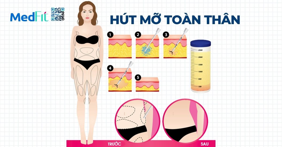 Hút mỡ toàn thân có nguy hiểm không? Những ưu điểm, rủi ro và lưu ý cần biết 1 Hút mỡ toàn thân là một dạng phẫu thuật thẩm mỹ nhằm loại bỏ mỡ thừa tích tụ tại nhiều vùng trên cơ thể như bụng, đùi, hông, cánh tay, lưng hay nọng cằm