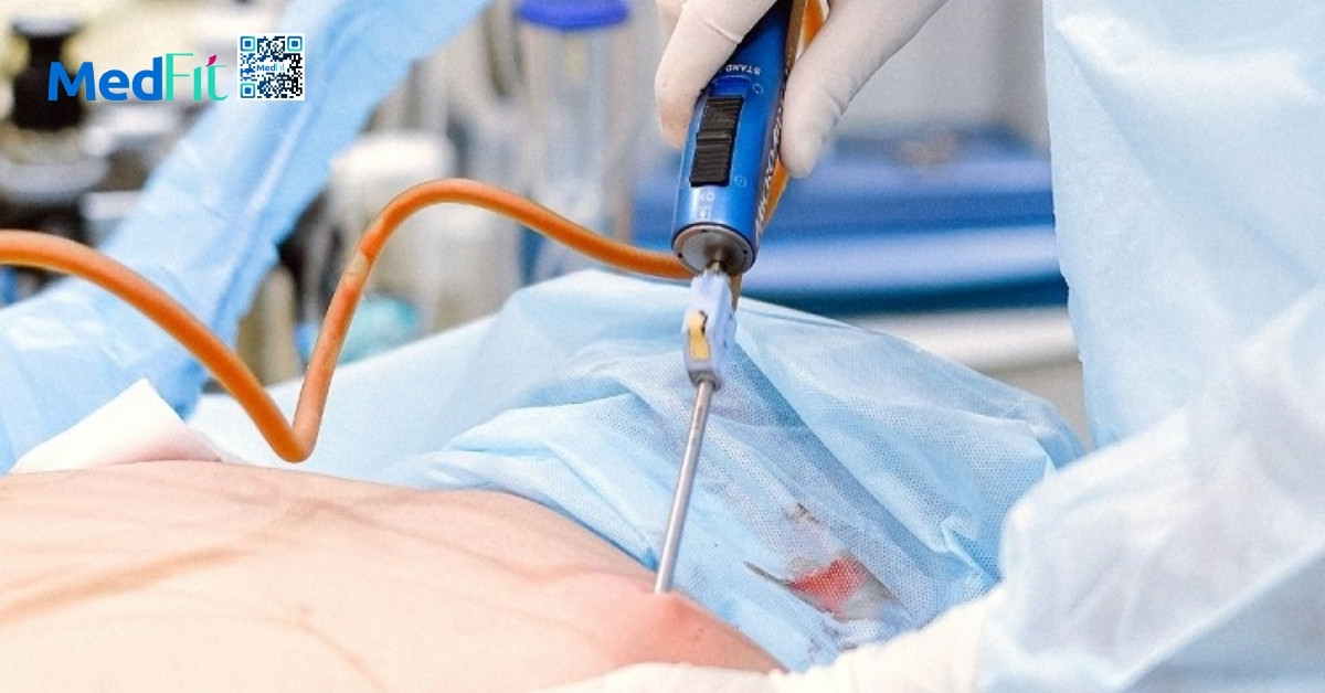 Hút mỡ toàn thân có nguy hiểm không? Những ưu điểm, rủi ro và lưu ý cần biết 2 Mỗi lần hút mỡ thường chỉ nên loại bỏ tối đa khoảng 5L dịch