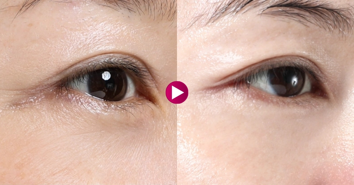 Làm đầy trũng mắt